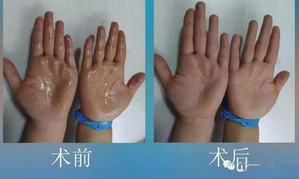 雙手四季“滴汗如雨”？微創(chuàng)手術(shù)來解憂