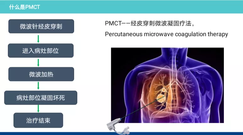 江西省胸科醫(yī)院腫瘤二科完成一例惡性腫瘤肺轉(zhuǎn)移高難度微波消融術(shù)