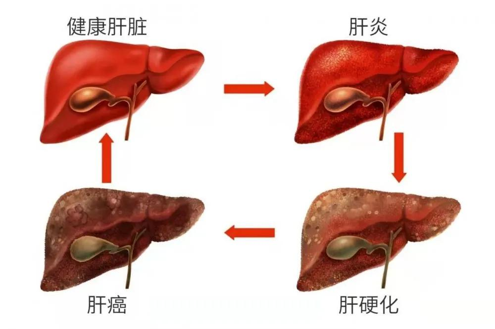 肝癌早期幾乎沒癥狀，如何預防或早期發(fā)現(xiàn)？